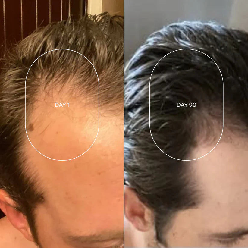 DHT BLOCKER - Deten la caida de cabello acelerada mientras recuperas tu cabello