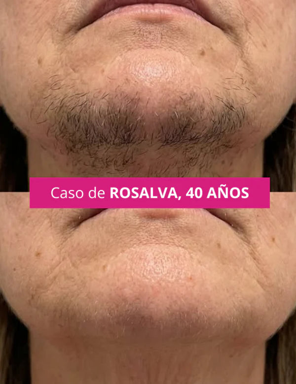 CYPERGLOW: INHIBIDOR DE VELLO FACIAL NO DESEADO PARA MUJERES