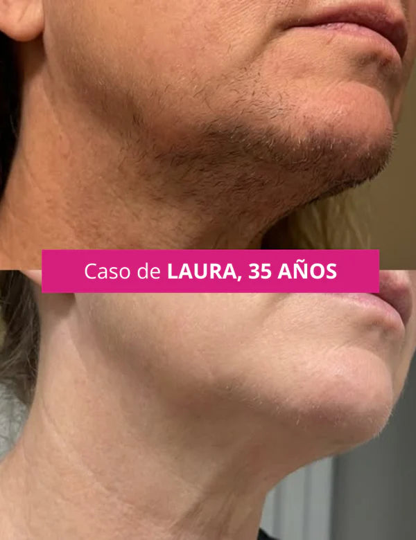 CYPERGLOW: INHIBIDOR DE VELLO FACIAL NO DESEADO PARA MUJERES