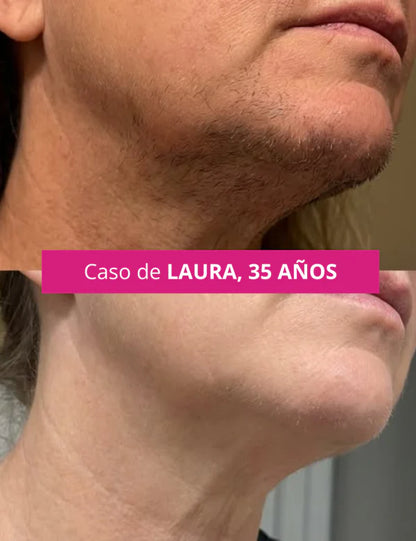 CYPERGLOW: INHIBIDOR DE VELLO FACIAL NO DESEADO PARA MUJERES