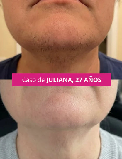 CYPERGLOW: INHIBIDOR DE VELLO FACIAL NO DESEADO PARA MUJERES