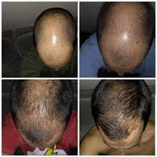 DHT BLOCKER - Deten la caida de cabello acelerada  mientras recuperas tu cabello